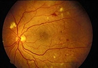 diabetic retinopathy