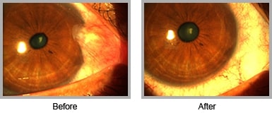 pterygium bna 1